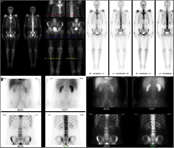 pic-nuclear-med-body-scan