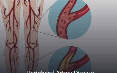 Peripheral Artery Disease – PAD
